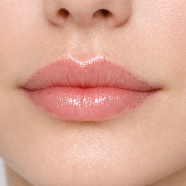 Хейлопластика - эстетическая и функциональная коррекция губ